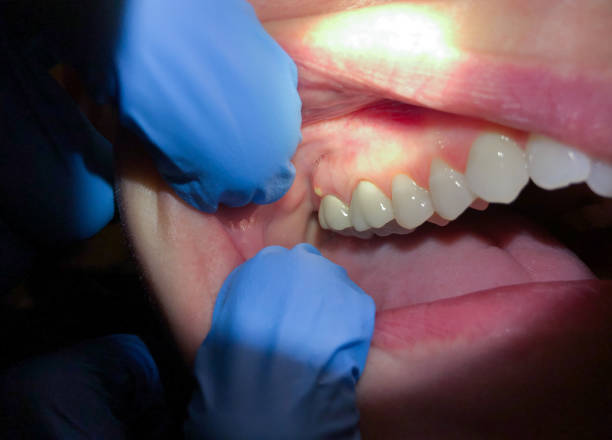 Best Chipped Tooth Repair Near Me  in Mableton, GA